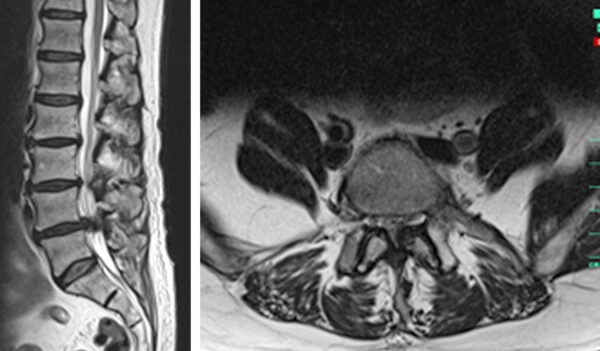 Kernspintomographie einer Spinalkanalstenose in dem Segment LWK4/5