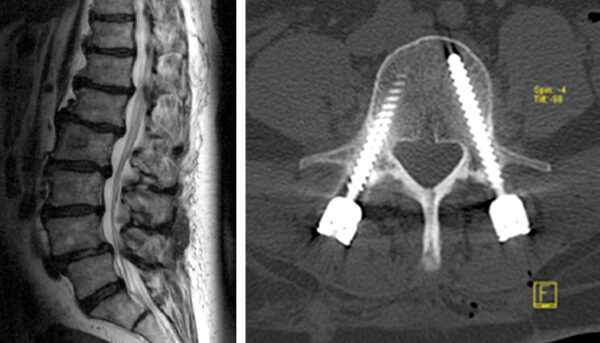 Degenerative Veränderungen der Lendenwirbelsäule mit Gleitwirbel (Spondylolisthese) des 4. und 5.Lendenwirbelkörpers mit begleitender Enge des Wirbelkanals. Kernspintomographie vor der Operation (links); Computertomographie des 4. Lendenwirbelköpers nach der Operation mit von hinten eingebrachten Schrauben 