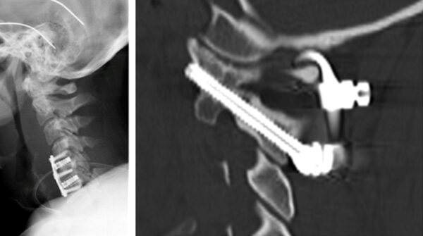 Postoperative Röntgenaufnahmen Postoperative Röntgenaufnahmen einer Fusion der Halswirbelsäule einer Fusion der Halswirbelsäule mit mit Cages und Platte über 2 Cages über 3 Segmente 